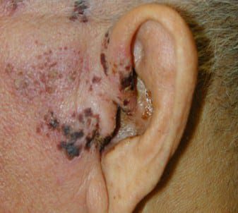 infeksi-herpes-zoster-otikus-8532858