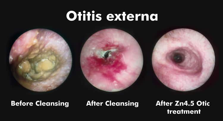 otitis-eksterna-5847098