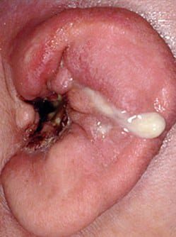 otitis-eksterna-maligna-9893438
