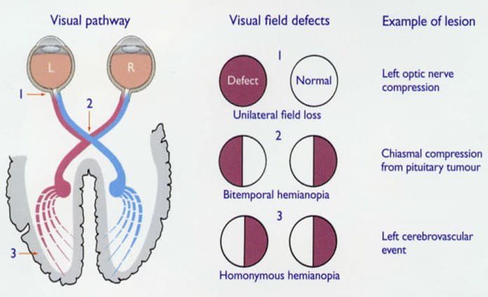 nervus-opticus-saraf-otak-ii-9630351