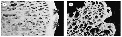 kelainan-pada-tulang-9116413