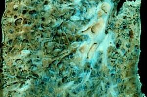 spesimen-paru-kasar-9054974-2374622-jpg