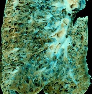 spesimen-paru-kasar-9054974-2374622-jpg